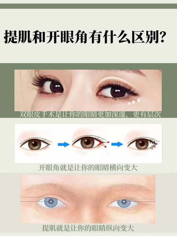 提肌和开眼角的区别.jpg
