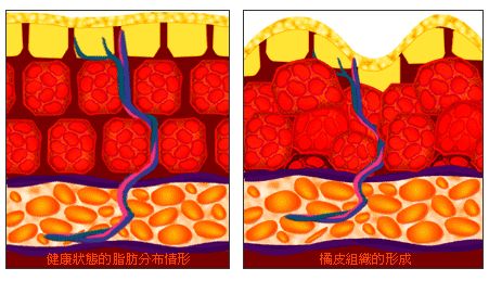 揭秘：为什么说LAMS（兰斯）吸脂是为夏天而生的吸脂术？