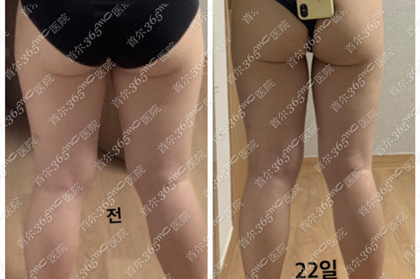 揭秘：为什么说LAMS（兰斯）吸脂是为夏天而生的吸脂术？