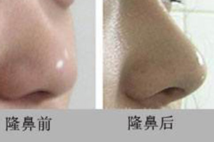 隆鼻前后对比图