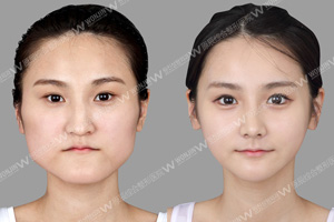 磨骨手术改脸型.jpg