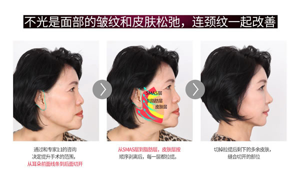 菲斯莱茵V脸提升.jpg