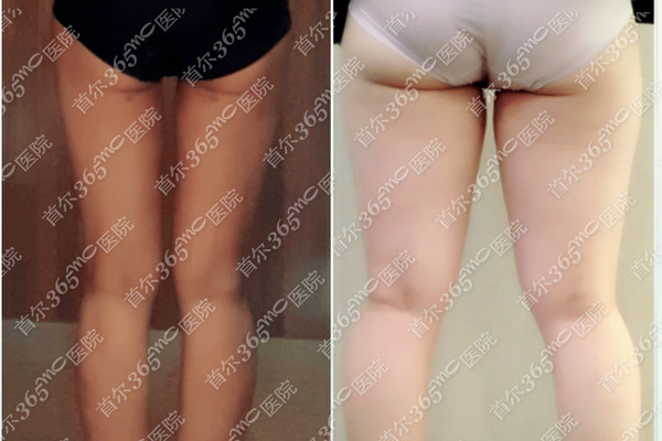 lams吸脂和vaser吸脂的区别？不仅仅是价格和效果哦！