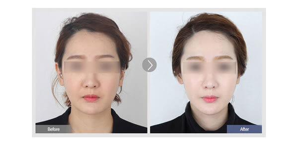 菲斯莱茵V脸提升术前术后对比图.jpg