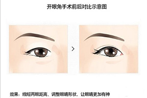 开眼角手术示意图.jpg