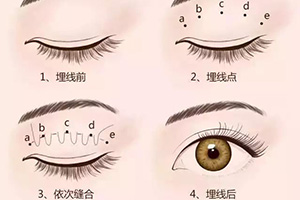 埋线法双眼皮.jpg