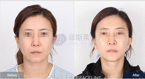 韩国菲斯莱茵整形医院小切口提升案例