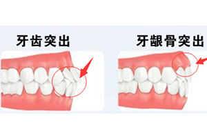 突嘴的两种情况.jpg