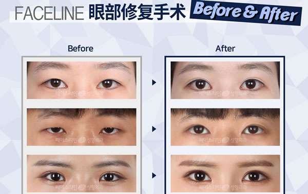 菲斯莱茵整形医院双眼皮修复案例.jpg