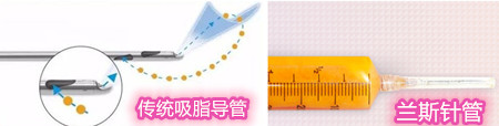 兰斯lams吸脂的价格是多少？兰斯lams吸脂和传统吸脂怎么选择好？