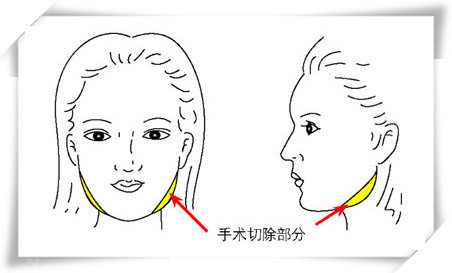 下颌角手术部位