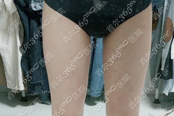 去韩国365mc兰斯lams大腿抽脂经历~一个月从55.8kg到50.2kg~