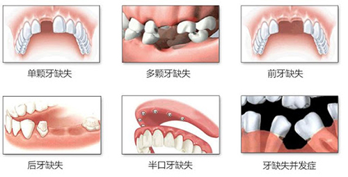 不同的牙缺失口腔情况