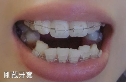 成年人牙齿矫正