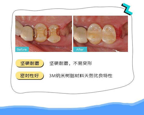 树脂补牙的方案.jpg