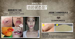 菲斯莱茵修复手术情况.png