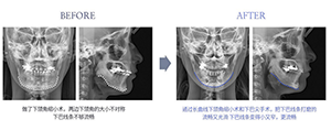 菲斯莱茵下颌角修复.png