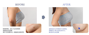 菲斯莱茵胸部修复.png
