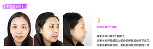 菲斯莱茵金喜恩术后.png