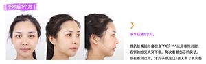 菲斯莱茵金喜恩术后.png