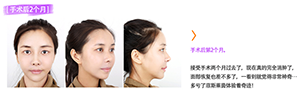 菲斯莱茵金喜恩术后.png