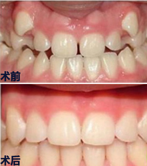 青岛维乐口腔医院牙齿矫正多少钱？