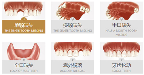 缺牙的各种情况