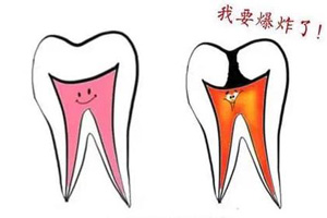 牙髓炎.jpg