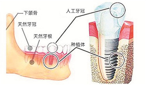 种植牙与真牙的对比