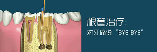 牙髓炎治疗价格