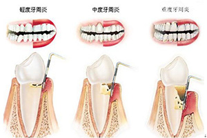 长沙牙周病治疗大概多少钱？