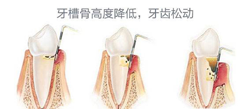 牙齿松动的原因