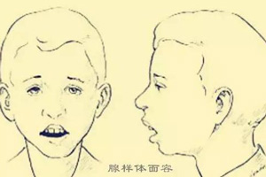 口呼吸导致面部变化