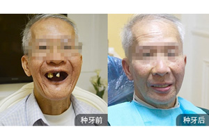 柏德口腔的美学种植