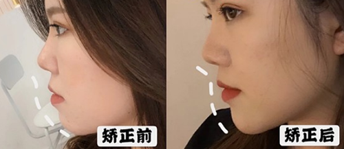轻微地包天牙齿矫正前后变化