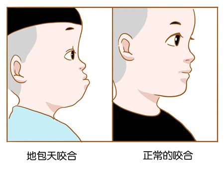 地包天和正常咬合的区别