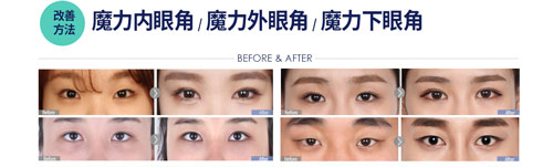菲斯莱茵开眼角改善手术