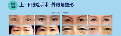 菲斯莱茵老颜眼眉矫正改善方法