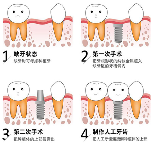 宁波恒美口腔医院种牙评价