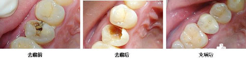 龋齿治疗效果对比