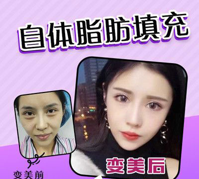 佛山梦露整形美容脂肪填充前后对比