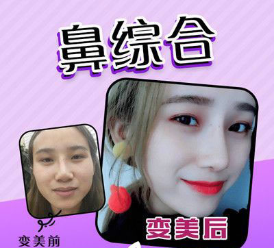 佛山梦露整形美容鼻综合前后对比