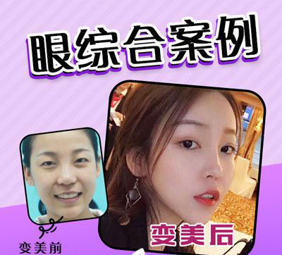 佛山梦露整形美容眼综合前后对比