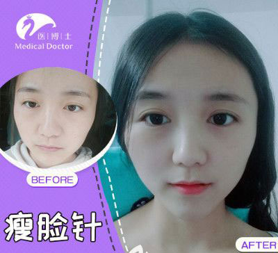 佛山医博士瘦脸针前后对比