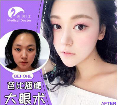 佛山医博士大眼术前后对比