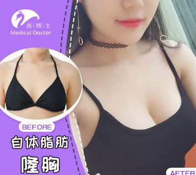 佛山医博士自体脂肪隆胸前后对比