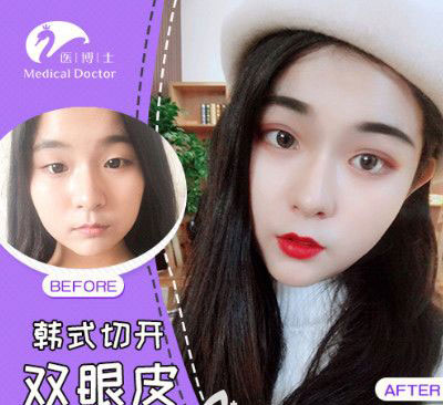 佛山医博士切开双眼皮