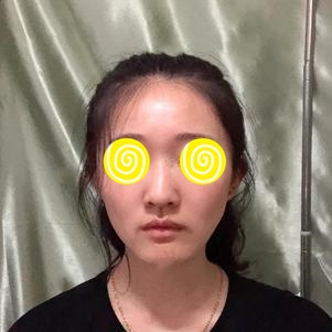 佛山苏李秀英热玛吉术前对比