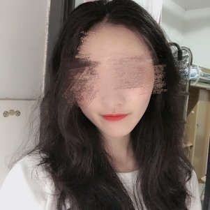 佛山苏李秀英热玛吉术后效果图
