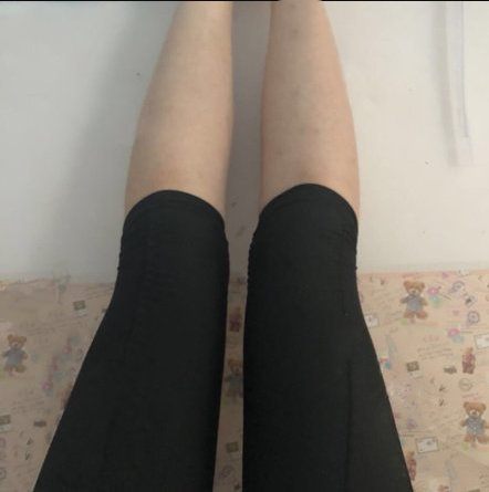 佛山苏李秀英整形医院大腿环吸案例